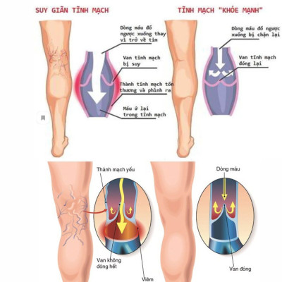 Máy nén ép trị liệu suy giãn tĩnh mạch chân Kachi MK394 - Hàng chính hãng