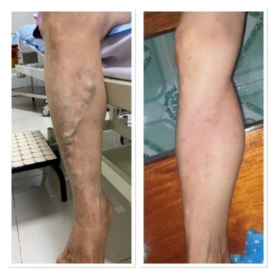 Máy nén ép trị liệu suy giãn tĩnh mạch chân Kachi MK394 - Hàng chính hãng