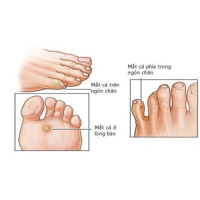 Miếng Dán Mụn Cóc Loại Bỏ Mụn Cóc Tại Nhà An Toàn ( Hộp 6 miếng ) Sản Phẩm Chăm Sóc Cá Nhân Khác