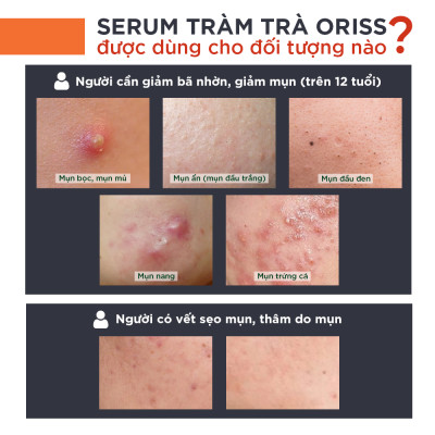 Serum Giảm Mụn Oriss Tinh Chất Tràm Trà Hỗ Trợ Mờ Thâm Sạch Mụn 10g