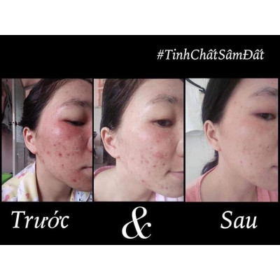 Tinh Chất Sâm Đất DR CELL 50ml tái tạo da, triệt tiêu mụn, mờ thâm nám, thu nhỏ chân lông