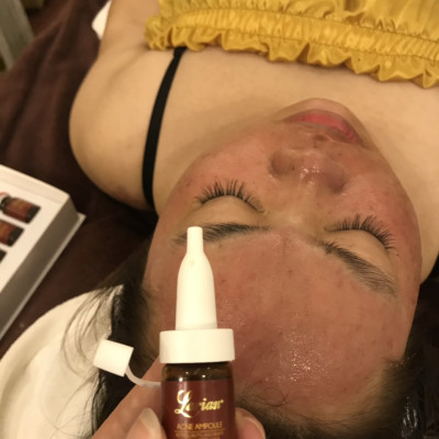 Tế bào gốc DNA cá hồi xóa sạch mụn,mờ thâm do mụn 8ml (LARIAN ACNE AMPOULE)