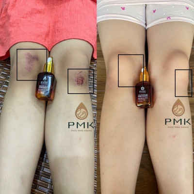 Tinh Chất Serum Mờ Thâm Minh Khang - Hết mọi loại thâm, an toàn, lành tính sử dụng mọi lứa tuổi